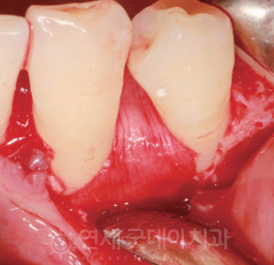 치과 잇몸치료 비용? 엠도게인 잇몸재생 사례 관련 이미지 12