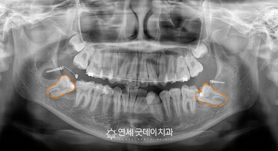 매복치아 견인교정 (feat. 구강외과 전문의 협진) 관련 이미지 6