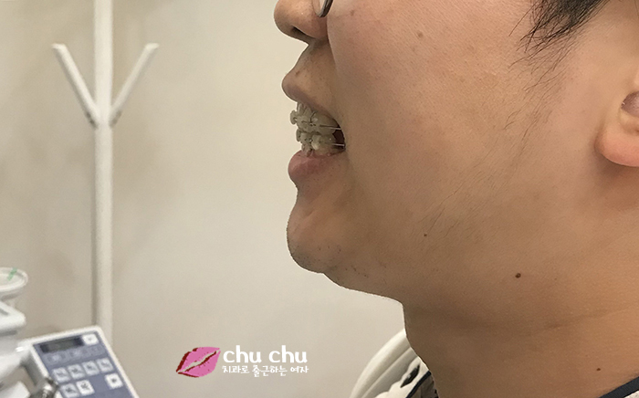 치아교정후기 2년간의 과정, 얼굴변화 (with 굿데이치과) 관련 이미지 6