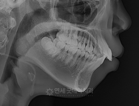 돌출입 무턱 치아교정 (15세 중학생) 관련 이미지 11
