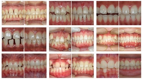 치아교정 클리피씨, 앞니교정 선착순 20명 추가 진행 中 이에요^^ (양재/수서) 관련 이미지 5