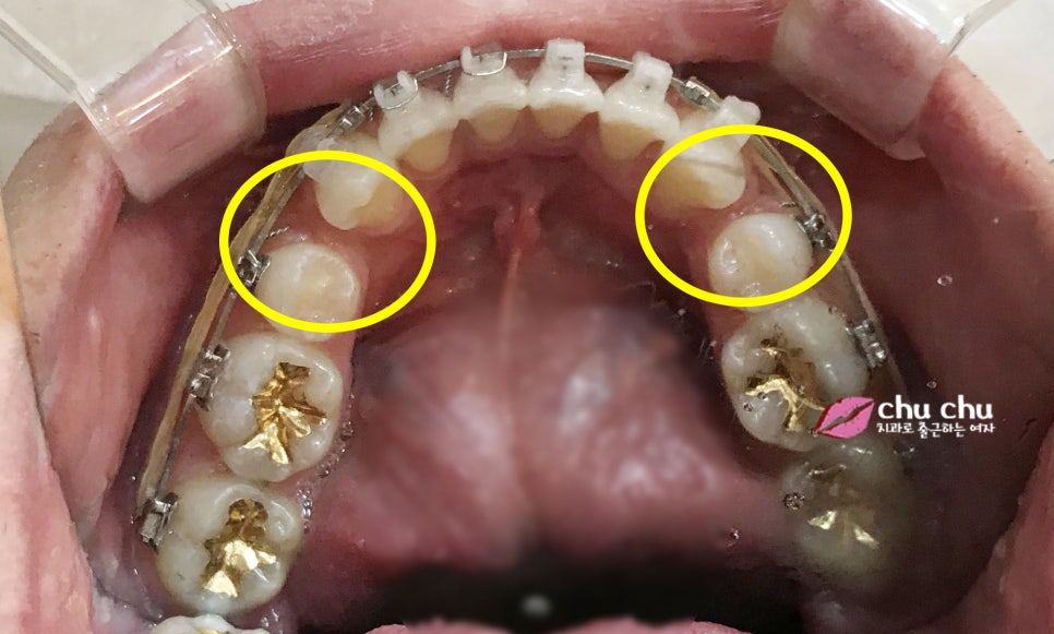 남자 돌출입교정일기 놀라운 변화! (1년, 365일 경과) 관련 이미지 3