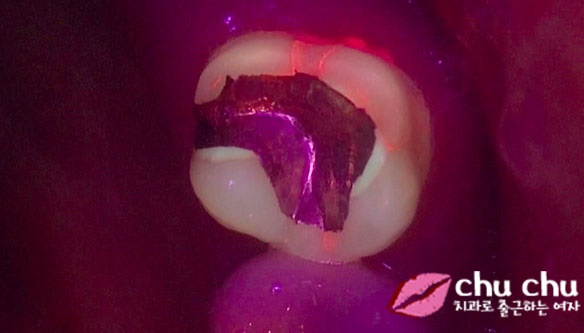 큐레이(Q-ray) &ndash; 플라그형광검사 시스템을 도입했습니다 :) 관련 이미지 5