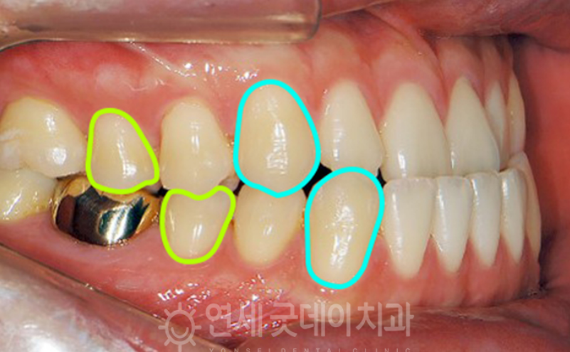 반대교합 교정 (30대 남성, 비발치) 관련 이미지 5