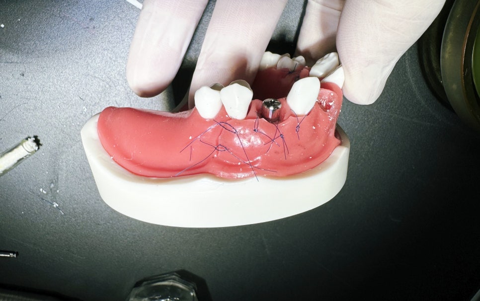 박정철 원장, 급속골이식(iGBR) 노하우를 세계각국으로! 관련 이미지 8