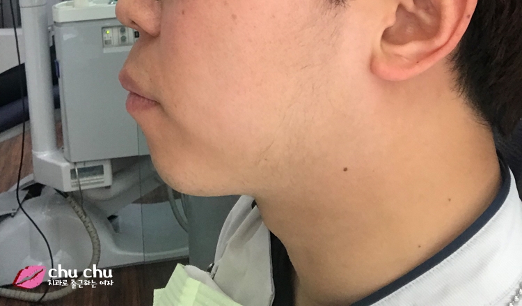 남자돌출입교정전후 - 지금도 ing 관련 이미지 2