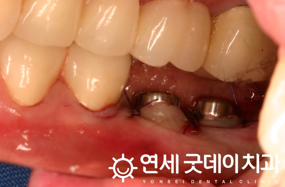 연세굿데이치과, 18년 장기보존 임플란트 증례발표 관련 이미지 2