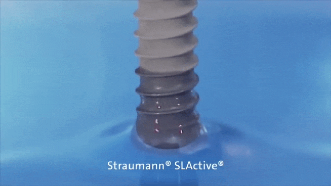 스트라우만 임플란트 탁월한 장기안정성 (ft. 70주년의 역사) 관련 이미지 5