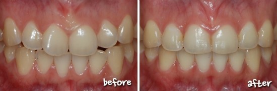 앞니교정 선착순 종료 되었어요! 성원에 감사드립니다^^ 관련 이미지 5