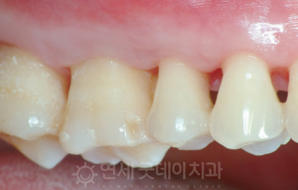 치과 잇몸치료 비용? 엠도게인 잇몸재생 사례 관련 이미지 9