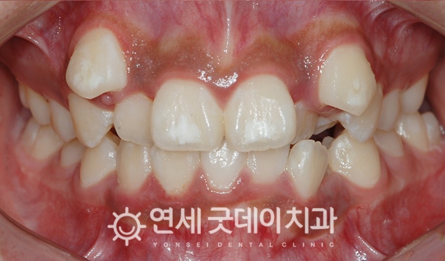매복치아 견인교정 (feat. 구강외과 전문의 협진) 관련 이미지 3