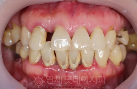 치과 잇몸치료 비용? 엠도게인 잇몸재생 사례 관련 이미지 3