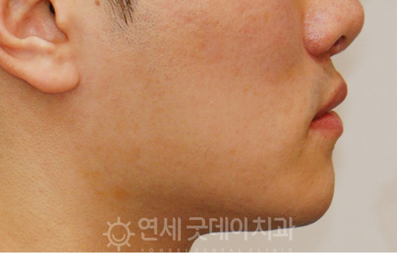 반대교합 교정 (30대 남성, 비발치) 관련 이미지 10