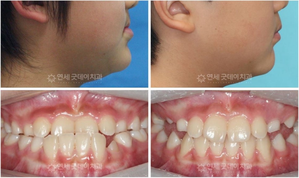 연세굿데이치과] 성장판 검사가 중요한 이유 관련 이미지 5