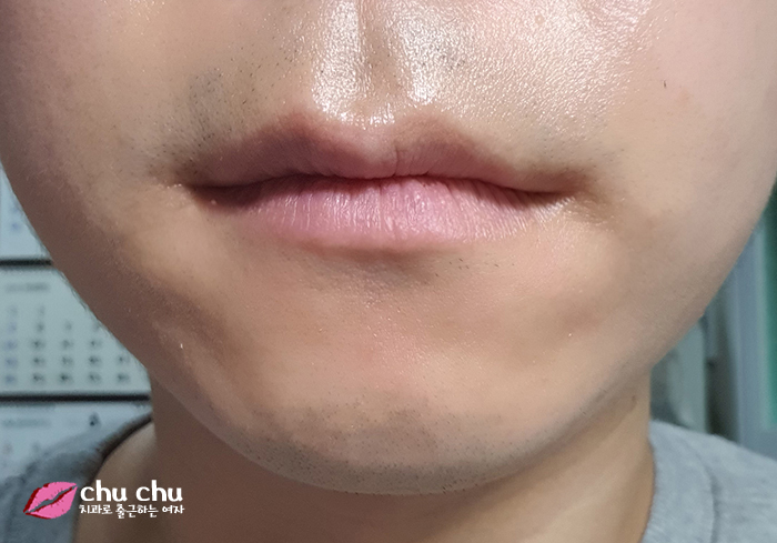 치아교정후기 2년간의 과정, 얼굴변화 (with 굿데이치과) 관련 이미지 10