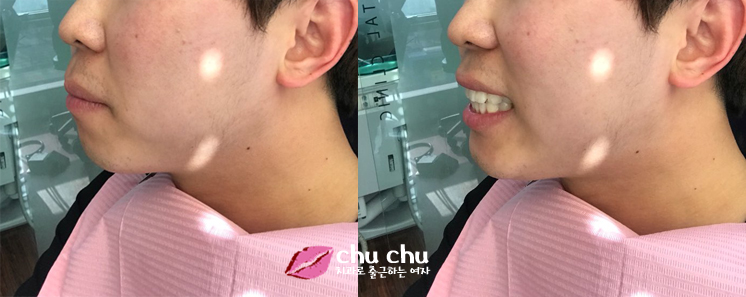 [ 연세굿데이 교정 ] 우리 직원이 달라졌어요 - 돌출입치아교정 start 관련 이미지 3