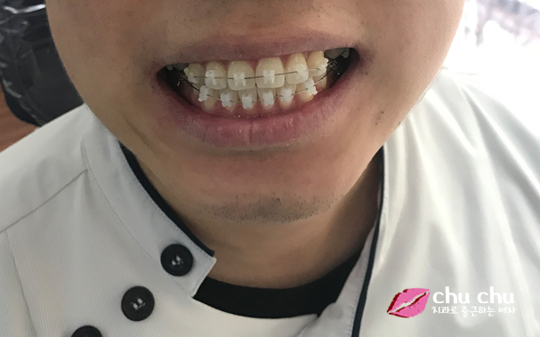 양재역 연세굿데이 - 하악 교정장치 붙이기까지 완료 !! 관련 이미지 2