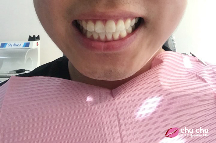 [ 연세굿데이 교정 ] 우리 직원이 달라졌어요 - 돌출입치아교정 start 관련 이미지 2