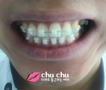 양재역 연세굿데이 - 하악 교정장치 붙이기까지 완료 !! 관련 이미지 1