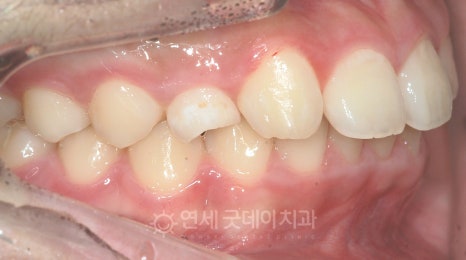 돌출입 무턱 치아교정 (15세 중학생) 관련 이미지 5