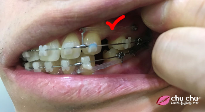 [ 교정4개월 ] 치아교정 파워체인 상/하악 모두 완료 관련 이미지 5