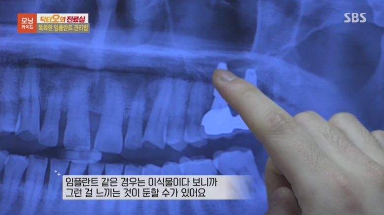 [이성화 원장님] SBS 모닝와이드 &lsquo;똑똑한 임플란트 관리법&rsquo; 출연 관련 이미지 7