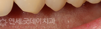 치과 잇몸치료 비용? 엠도게인 잇몸재생 사례 관련 이미지 21
