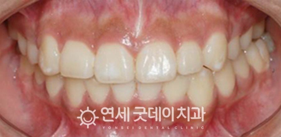 매복치아 견인교정 (feat. 구강외과 전문의 협진) 관련 이미지 13