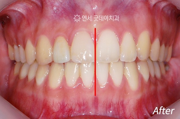치아중심선 비대칭 교정 관련 이미지 9