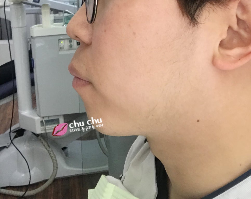 튀어나온 입 변화과정 (2018.03 ~) 관련 이미지 3