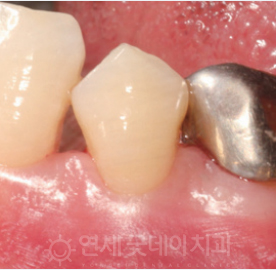 치과 잇몸치료 비용? 엠도게인 잇몸재생 사례 관련 이미지 11