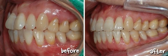 앞니교정 선착순 종료 되었어요! 성원에 감사드립니다^^ 관련 이미지 6