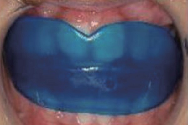 프리올소 장치안내 (ft. 어린이 부정교합 교정 편) 관련 이미지 12