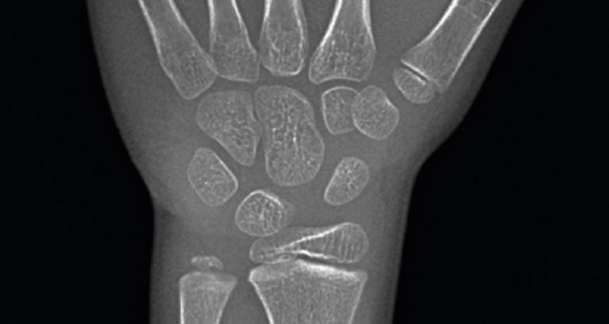 연세굿데이치과] 성장판 검사가 중요한 이유 관련 이미지 3