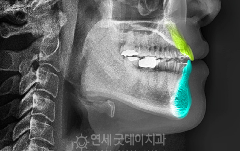 반대교합 교정 (30대 남성, 비발치) 관련 이미지 8