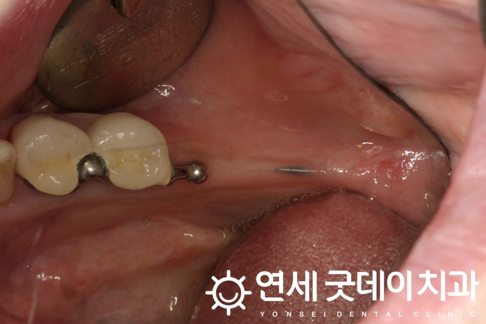 연세굿데이치과, 18년 장기보존 임플란트 증례발표 관련 이미지 3