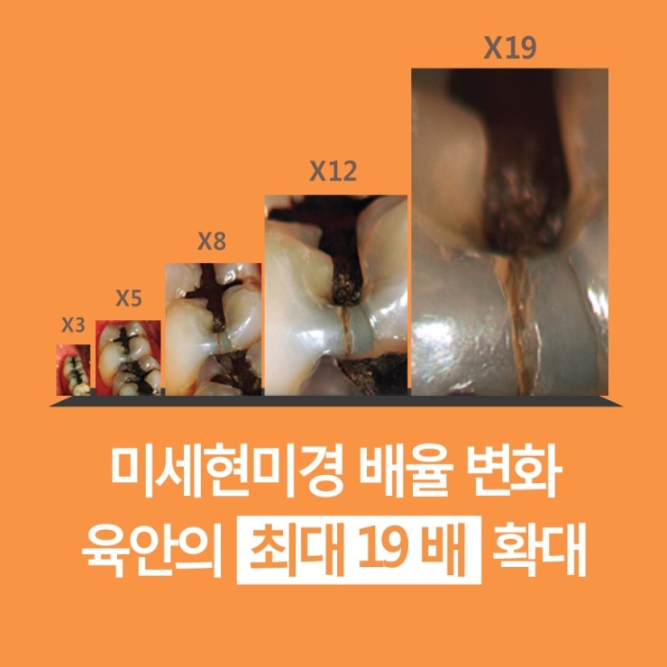 눈으로 보는 것보다 19배 확대되는 미세현미경, 치아살리기에 사용됩니다 ^^ 관련 이미지 6