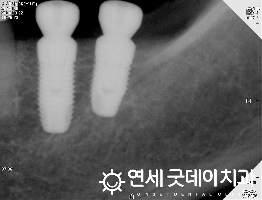 연세굿데이치과, 18년 장기보존 임플란트 증례발표 관련 이미지 7