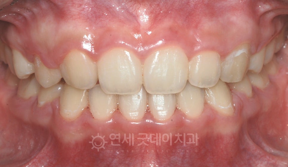돌출입 무턱 치아교정 (15세 중학생) 관련 이미지 8