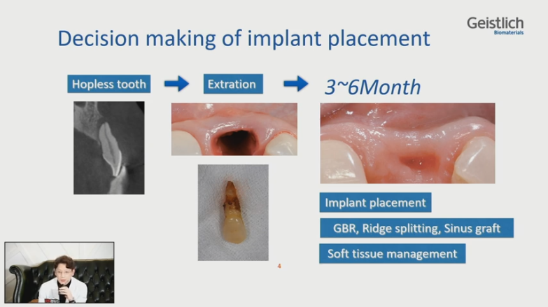 [Dr.정재욱] 치조제보존술(ARP) 유튜브 실시간 온라인강연 관련 이미지 11