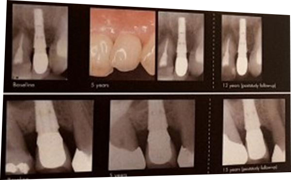 아스트라 임플란트(Astra implant) &ndash; 스웨덴산과 국산의 차이점!? 관련 이미지 2