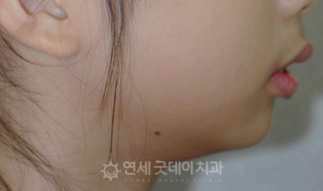 프리올소 장치안내 (ft. 어린이 부정교합 교정 편) 관련 이미지 15