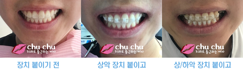 양재역 연세굿데이 - 하악 교정장치 붙이기까지 완료 !! 관련 이미지 5