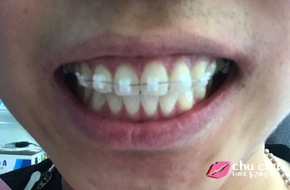 [ 연세굿데이 교정 ] 우리 직원이 달라졌어요 - 돌출입치아교정 start 관련 이미지 6