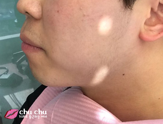 치아교정후기 2년간의 과정, 얼굴변화 (with 굿데이치과) 관련 이미지 1