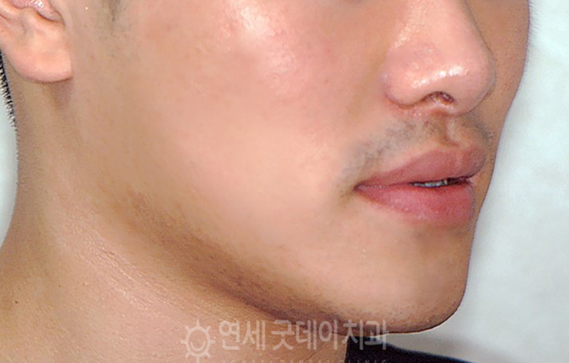 반대교합 교정 (30대 남성, 비발치) 관련 이미지 1