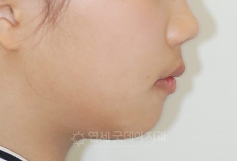 돌출입 무턱 치아교정 (15세 중학생) 관련 이미지 7
