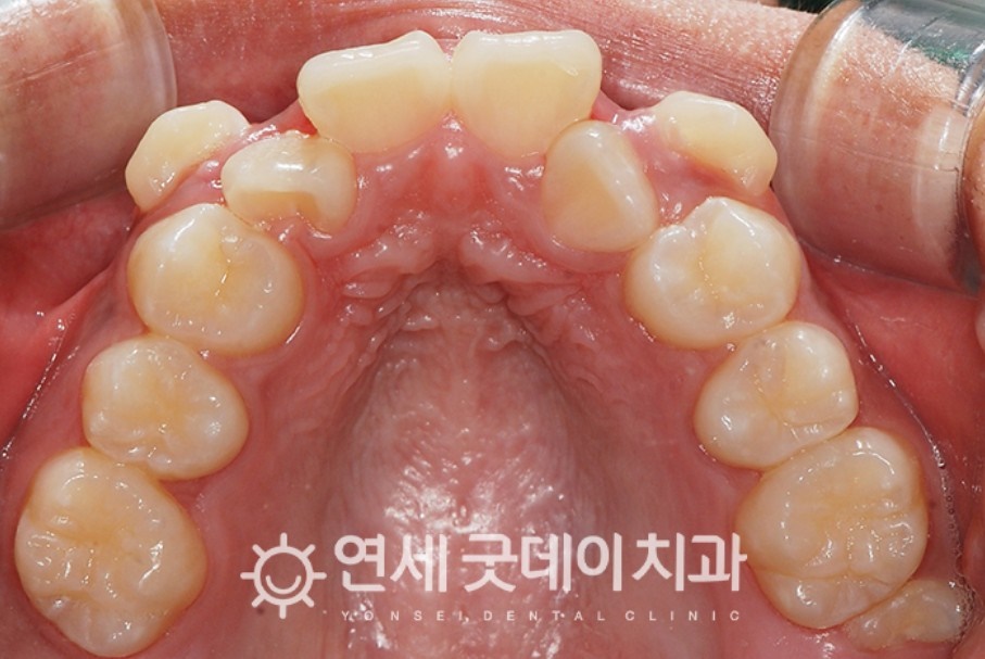 매복치아 견인교정 (feat. 구강외과 전문의 협진) 관련 이미지 9