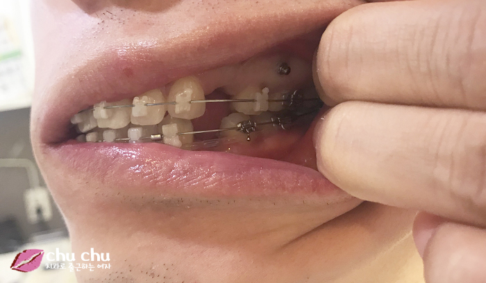 치아교정후기 2년간의 과정, 얼굴변화 (with 굿데이치과) 관련 이미지 4