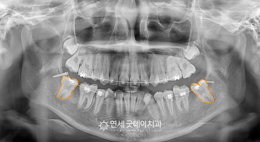 매복치아 견인교정 (feat. 구강외과 전문의 협진) 관련 이미지 7